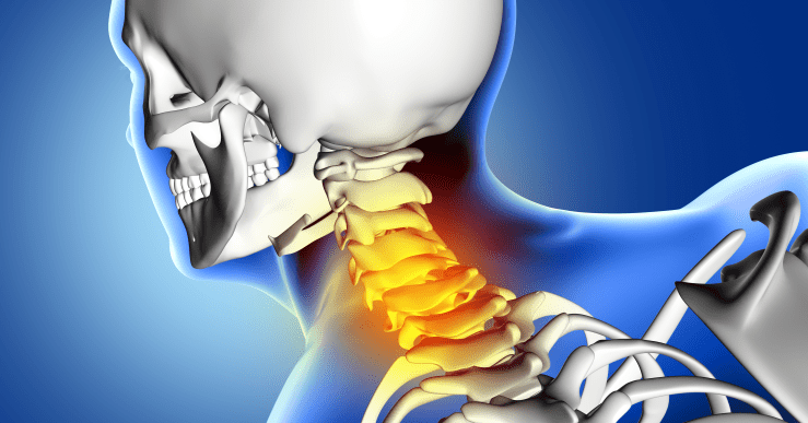 Signs Symptoms How To Identify Cervical Pain Dr Anil Dhingra